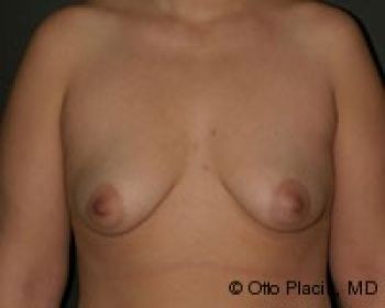 Before & After Breast Augmentation Gallery - Before & After - Dr. Placik