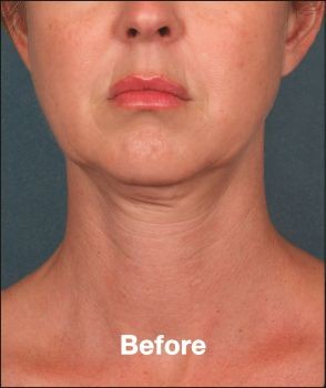 Kybella - Before & After - Dr. Placik