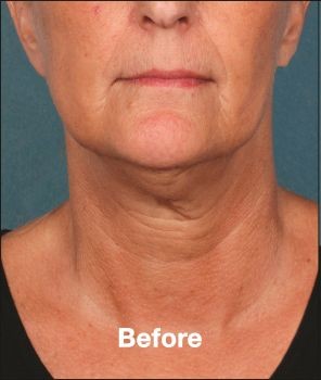 Kybella - Before & After - Dr. Placik