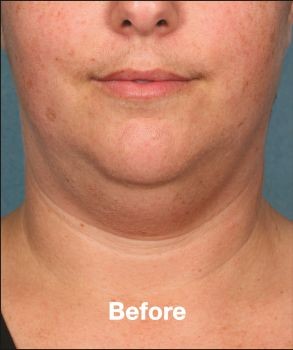 Kybella - Before & After - Dr. Placik