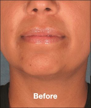 Kybella - Before & After - Dr. Placik