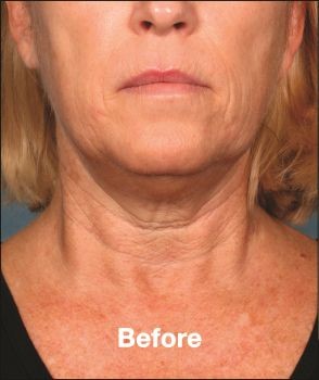 Kybella - Before & After - Dr. Placik