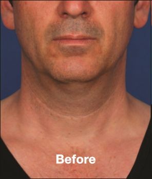 Kybella - Before & After - Dr. Placik