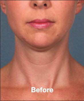 Kybella - Before & After - Dr. Placik