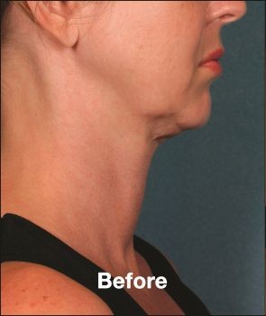 Kybella - Before & After - Dr. Placik