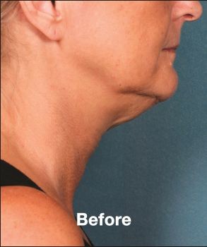 Kybella - Before & After - Dr. Placik