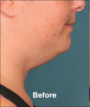 Kybella - Before & After - Dr. Placik