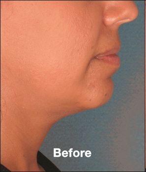 Kybella - Before & After - Dr. Placik