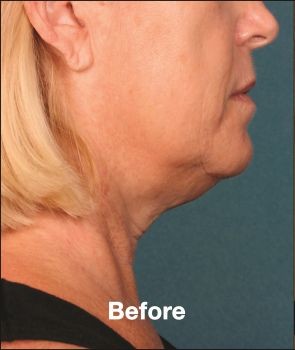 Kybella - Before & After - Dr. Placik