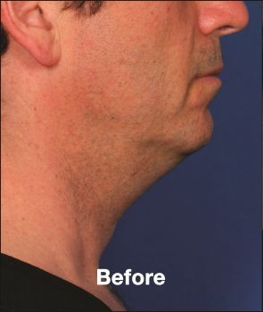 Kybella - Before & After - Dr. Placik