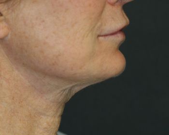 Lipoinjections to Various Facial Areas - Before & After - Dr. Placik