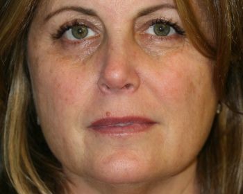 Lipoinjections to Various Facial Areas - Before & After - Dr. Placik