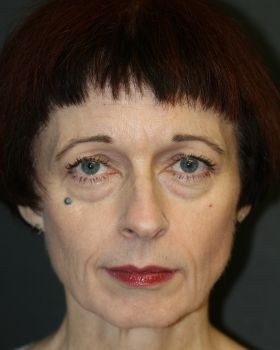 Vampire Facelift - Before & After - Dr. Placik