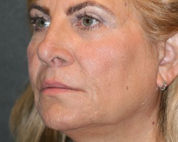 Vampire Facelift - Before & After - Dr. Placik