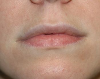 Lip Lift - Before & After - Dr. Placik