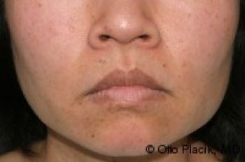 Lip Lift - Before & After - Dr. Placik