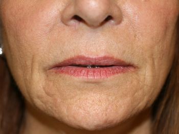 Lip Lift - Before & After - Dr. Placik