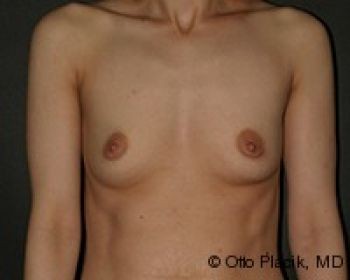 Before & After Breast Augmentation Gallery - Before & After - Dr. Placik