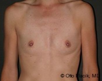 Before & After Breast Augmentation Gallery - Before & After - Dr. Placik