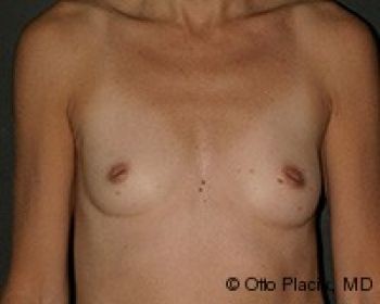 Before & After Breast Augmentation Gallery - Before & After - Dr. Placik