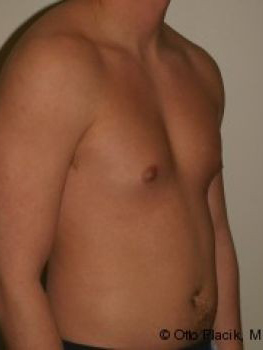 Male Breast Reduction - Before & After - Dr. Placik