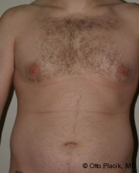 Male Breast Reduction - Before & After - Dr. Placik