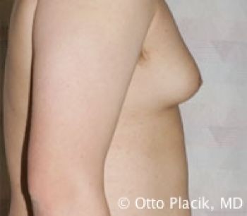 Male Breast Reduction - Before & After - Dr. Placik