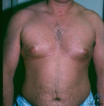 Male Breast Reduction - Before & After - Dr. Placik