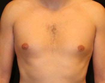 Male Breast Reduction - Before & After - Dr. Placik