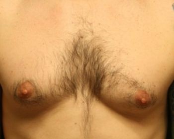 Male Breast Reduction - Before & After - Dr. Placik