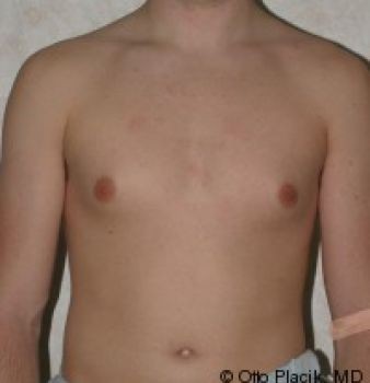 Male Breast Reduction - Before & After - Dr. Placik