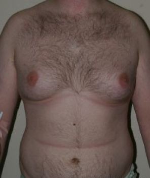 Male Breast Reduction - Before & After - Dr. Placik