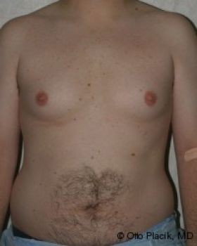 Male Breast Reduction - Before & After - Dr. Placik