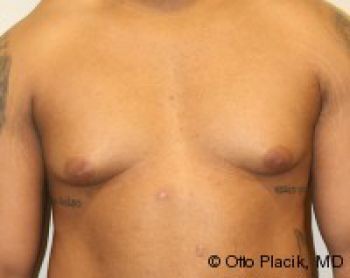 Male Breast Reduction