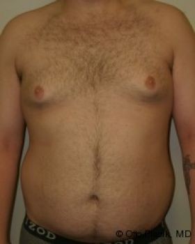 Male Breast Reduction