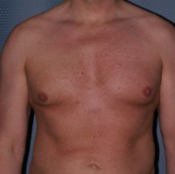 Male Breast Reduction - Before & After - Dr. Placik