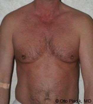 Male Breast Reduction - Before & After - Dr. Placik