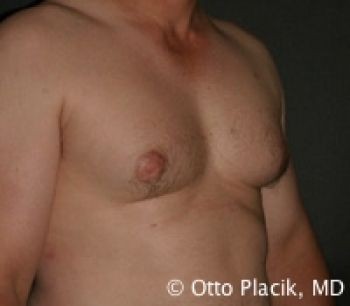 Male Breast Reduction - Before & After - Dr. Placik