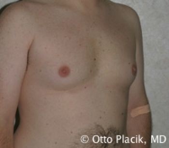 Male Breast Reduction - Before & After - Dr. Placik