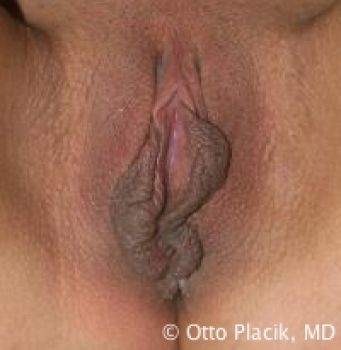 Labiaplasty with and without Clitoral Hood Reduction - Before & After - Dr. Placik