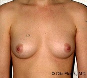 Before & After Breast Augmentation Gallery - Before & After - Dr. Placik