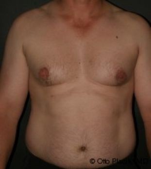 Male Breast Reduction - Before & After - Dr. Placik