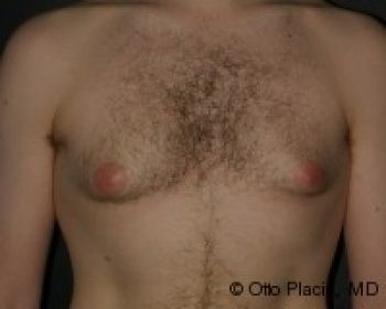 Male Breast Reduction - Before & After - Dr. Placik