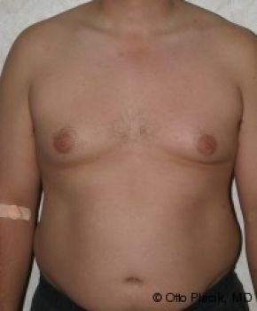 Male Breast Reduction - Before & After - Dr. Placik