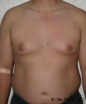 Male Breast Reduction - Before & After - Dr. Placik