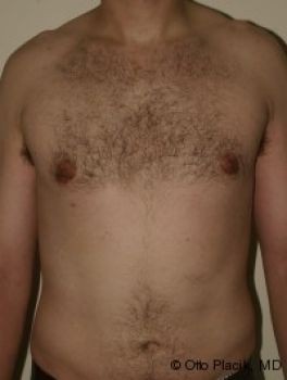 Male Breast Reduction - Before & After - Dr. Placik