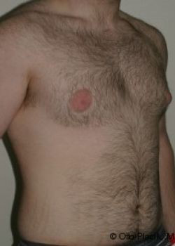 Male Breast Reduction - Before & After - Dr. Placik