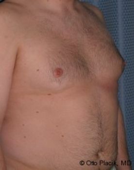 Male Breast Reduction - Before & After - Dr. Placik