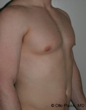 Male Breast Reduction - Before & After - Dr. Placik