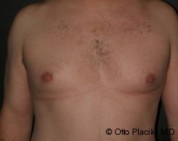 Male Breast Reduction - Before & After - Dr. Placik